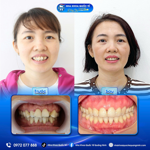 nha-khoa-quoc-te-quang-ninh5-1757490246.png