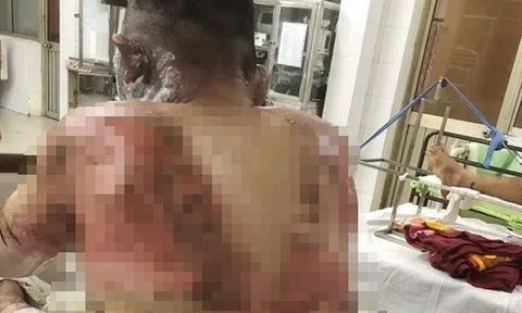 Vụ cháy tại Công ty TNHH Xin Rong: Nỗ lực cứu chữa một công nhân bị bỏng nặng
